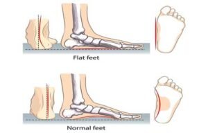 Flat Feet vs Normal Feet