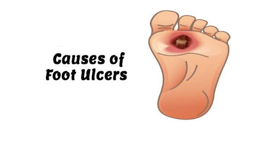 Causes of Foot Ulcer Causes of Foot Ulcer