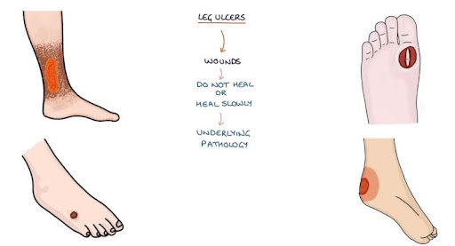 Foot Ulcer Foot Ulcer