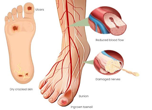 diabetic foot ulcer pictures 