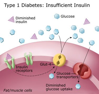 Type 1 Diabetes Type-1 Diabetes