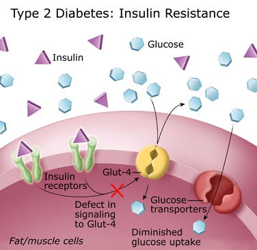 Type 2 Diabetes Type-2 Diabetes