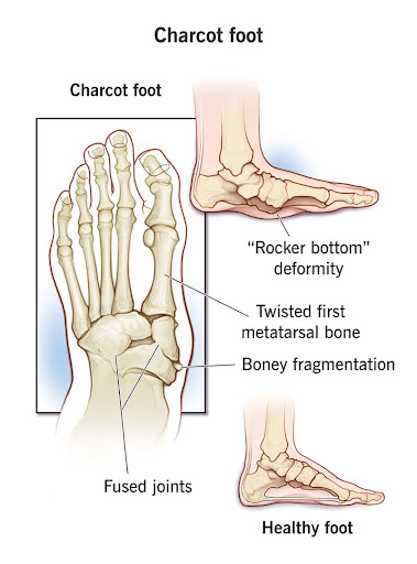 Charcot Joint of Foot charcot joint of foot