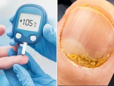 Diabetes and Fingernail Fungus Diabetes and Fingernail Fungus