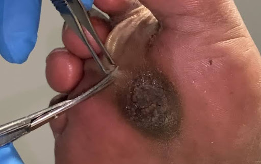 Calluses or Blisters on Foot Calluses or Blisters