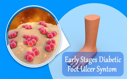 Early Stages Diabetic Foot Ulcer Symptom Early Stages Diabetic Foot Ulcer Symptom