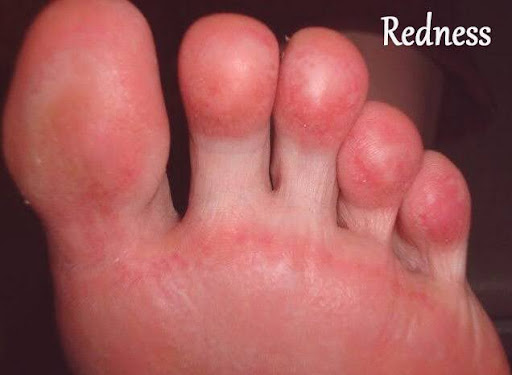 Redness on Foot Redness