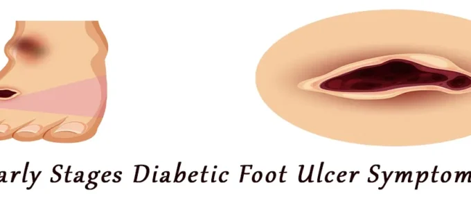 Early Stages Diabetic Foot Ulcer Symptom