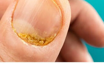 Fingernail Fungus Fingernail Fungus