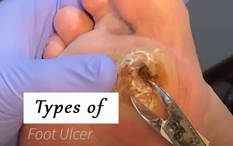 What is A Foot Ulcer: Causes of Foot Ulcer 1 foot ulcer types