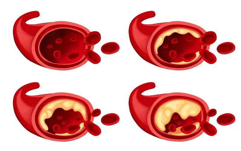 What is A Foot Ulcer: Causes of Foot Ulcer 2 poor blood circulation